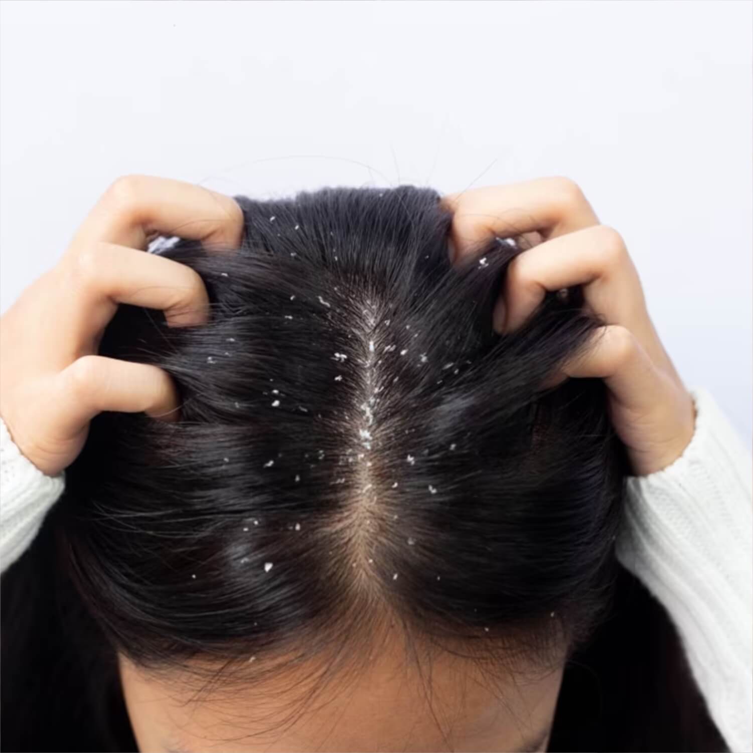 Dandruff Treatment in Navi Mumbai